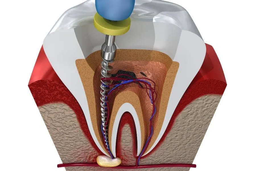 Dentist in Bay Harbor Root canal treatment process. 3D illustration