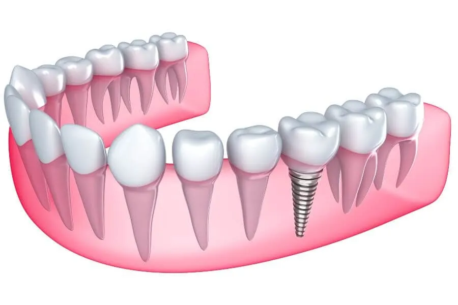 Dental Implants in Plantation General Dentistry Artisa Dental 754-755-6350