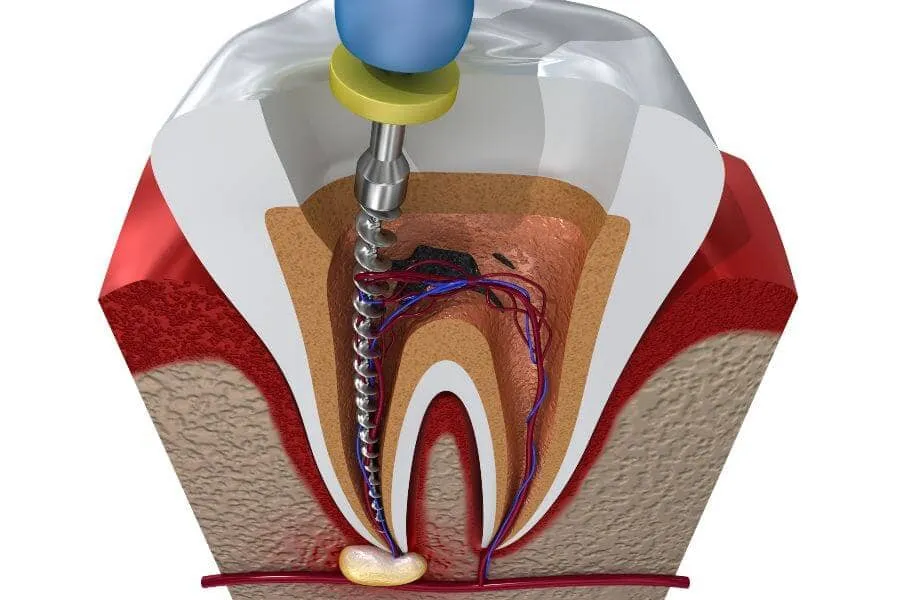 Root Canal Treatment in Plantation Dentist in Plantation General Dentistry Artisa Dental 754-755-6350
