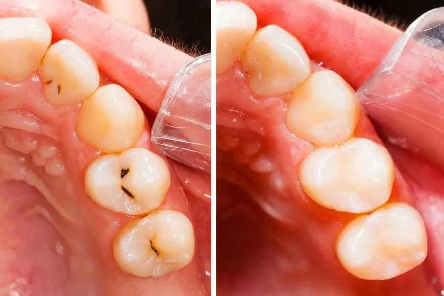 Dental Fillings - Dentist in Plantation General Dentistry Artisa Dental (754) 755-6350
