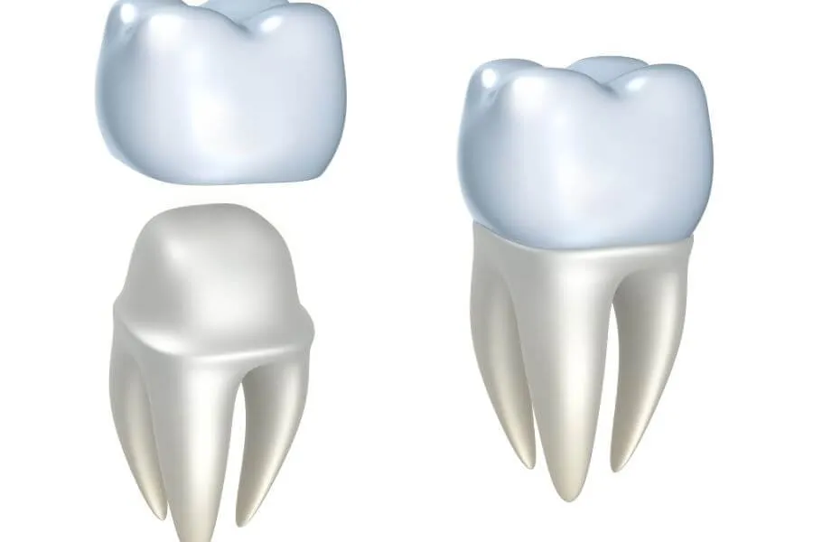 Dental Crowns Dentist in Plantation General Dentistry Artisa Dental (754) 755-6350