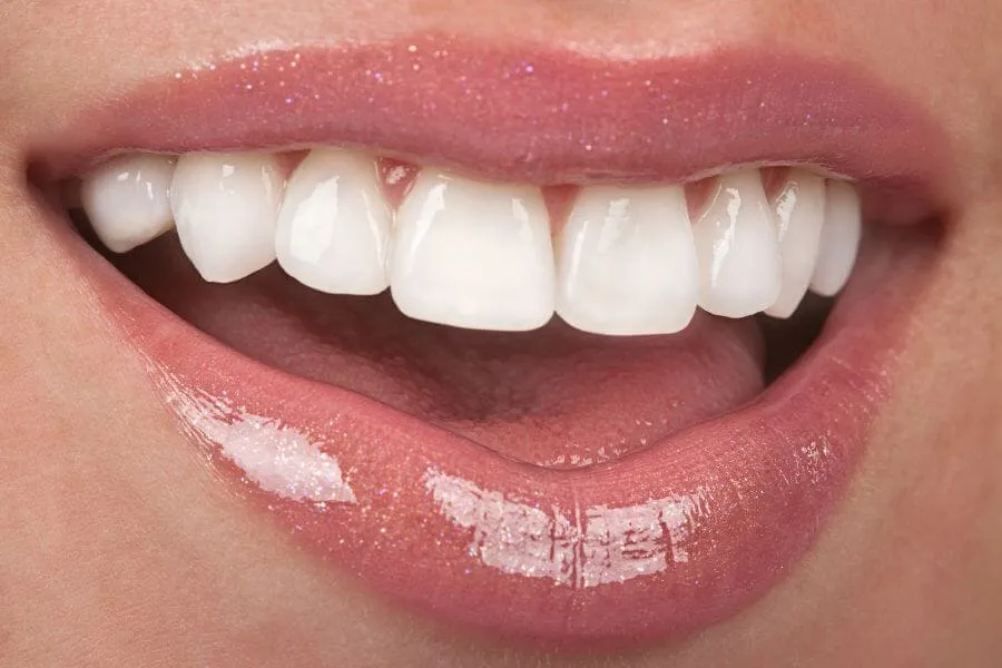 Veneers in Plantation Dentist in Plantation General Dentistry services Artisa Dental 754-755-6350