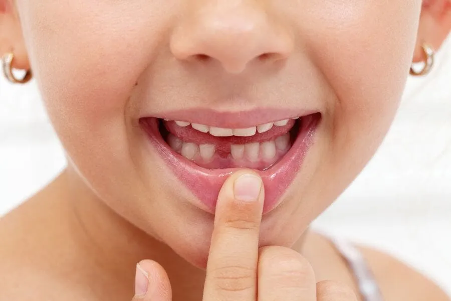 Dental Extractions in Plantation - Dentist in Plantation General Dentistry Artisa Dental 754-755-6350